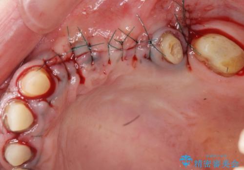 骨造成を行ったインプラント治療の治療中
