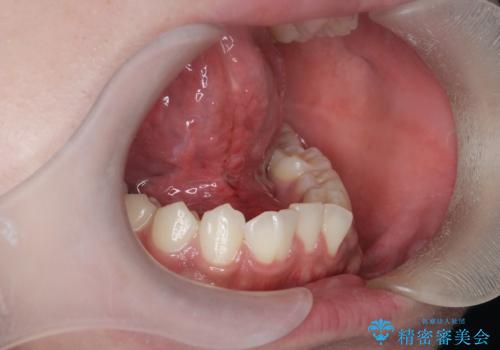 滑舌の改善　舌小帯の形成術の症例 治療後