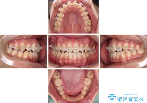 ワイヤー矯正を併用したインビザライン矯正治療の治療中