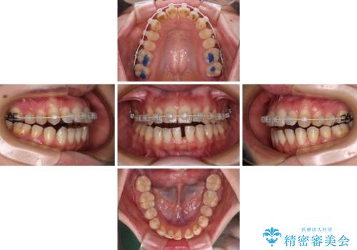 開咬と歯の欠損　ワイヤー装置を併用したインビザライン矯正治療の治療中