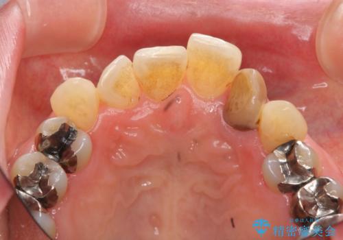 前歯の審美障害　セラミック治療の治療前
