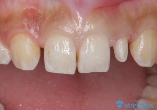 変色した前歯をキレイにしたい ジルコニアクラウンでの修復の治療中
