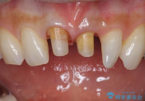 前歯をキレイにしたい ジルコニアクラウンでの治療の治療中