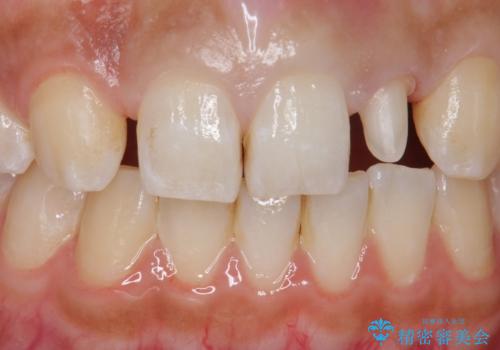 変色した前歯をキレイにしたい ジルコニアクラウンでの修復の治療中