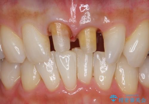 前歯をキレイにしたい ジルコニアクラウンでの治療の治療中