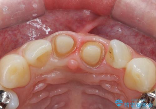 前歯をキレイにしたい ジルコニアクラウンでの治療の治療中