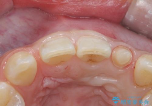 変色した前歯をキレイにしたい ジルコニアクラウンでの修復の治療中