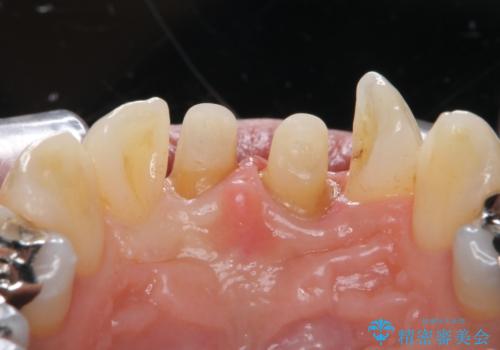 前歯をキレイにしたい ジルコニアクラウンでの治療の治療中