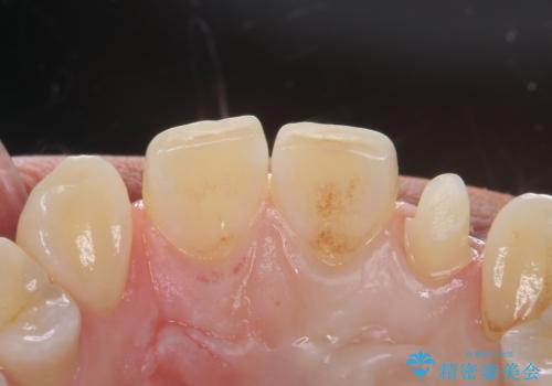 変色した前歯をキレイにしたい ジルコニアクラウンでの修復の治療中