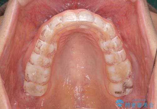 夜中の歯ぎしり ナイトガードで予防の治療後