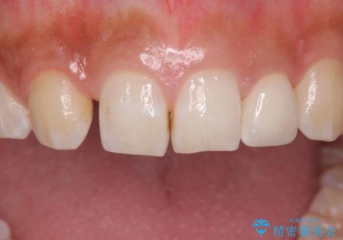 変色した前歯をキレイにしたい ジルコニアクラウンでの修復の治療後