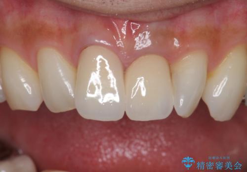 前歯をキレイにしたい ジルコニアクラウンでの治療の治療後