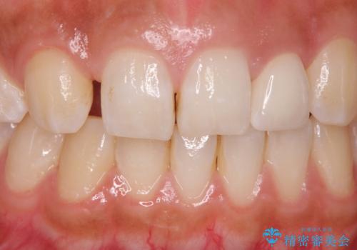 変色した前歯をキレイにしたい ジルコニアクラウンでの修復の症例 治療後
