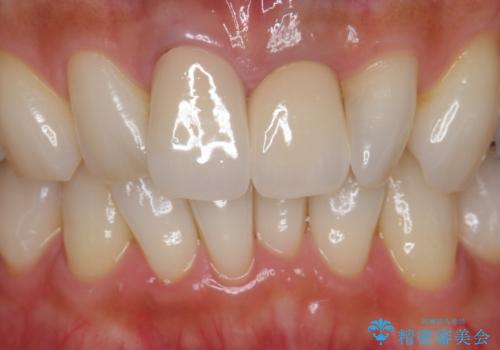 前歯をキレイにしたい ジルコニアクラウンでの治療の治療後