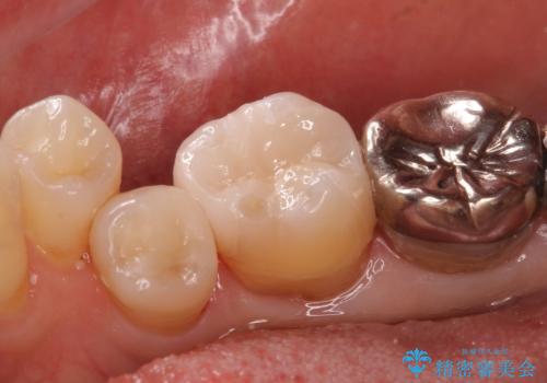 歯がかけた セラミックインレーでの治療の治療後