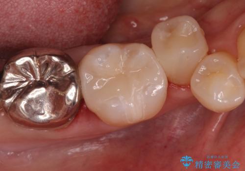 歯がかけた セラミックインレーでの治療の症例 治療後