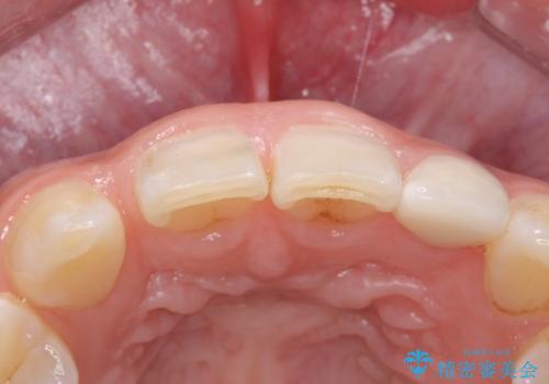 変色した前歯をキレイにしたい ジルコニアクラウンでの修復の治療後