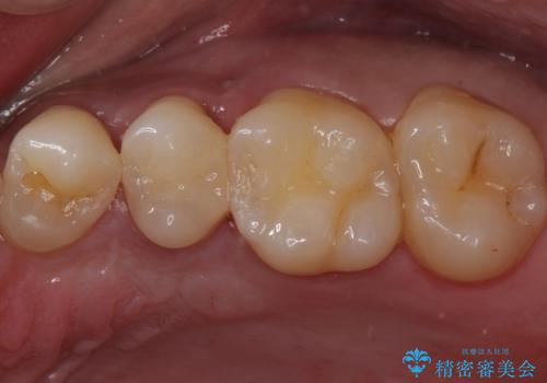 歯と歯の間の虫歯　セラミックインレーでの治療の症例 治療後