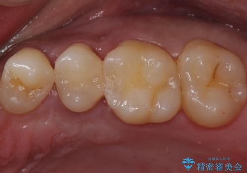 歯と歯の間の虫歯　セラミックインレーでの治療の治療後