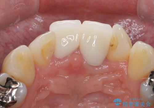 前歯をキレイにしたい ジルコニアクラウンでの治療の治療後