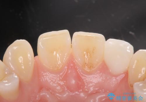 変色した前歯をキレイにしたい ジルコニアクラウンでの修復の治療後