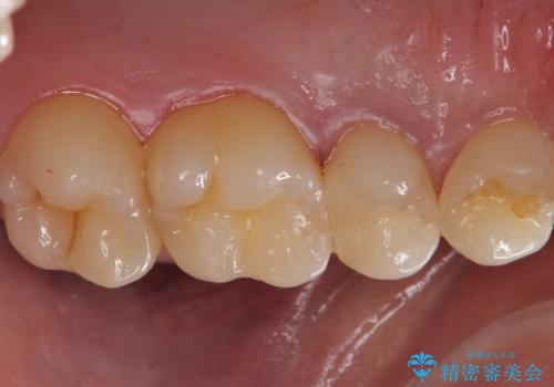 歯と歯の間の虫歯　セラミックインレーでの治療の治療後
