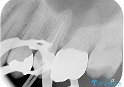 【根管治療・オールセラミッククラウン】何もしなくても歯が痛い 咬むと更に痛いの治療中