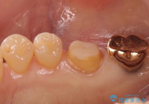 虫歯の治療 できれば歯の向きも変えたいの治療中