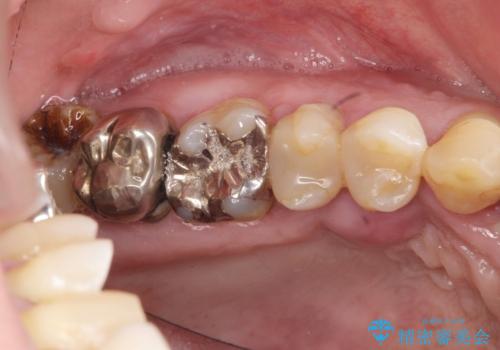 [ 重度の歯周病 ] 骨の造成を伴う奥歯インプラント治療の治療前
