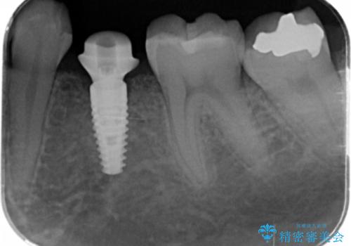 乳歯の残存　インプラントによる置き換えの治療中