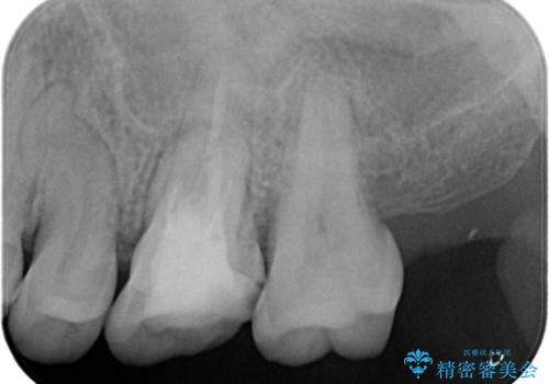 【見逃し根管を発見】根管治療〜セラミッククラウンの治療前
