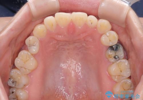 隙間の空いた歯列とボロボロの乳歯 インプラント治療と矯正治療の治療前