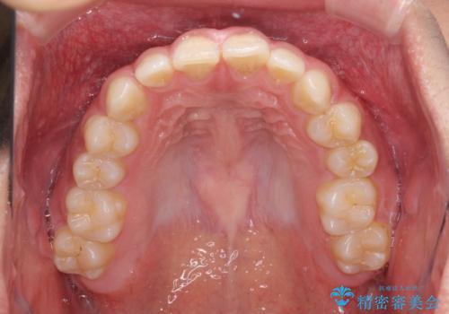 隙間とデコボコを治したい ワイヤー装置による矯正治療の治療前