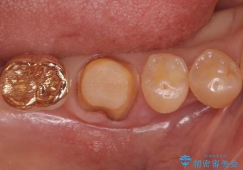 虫歯の治療 できれば歯の向きも変えたいの治療中