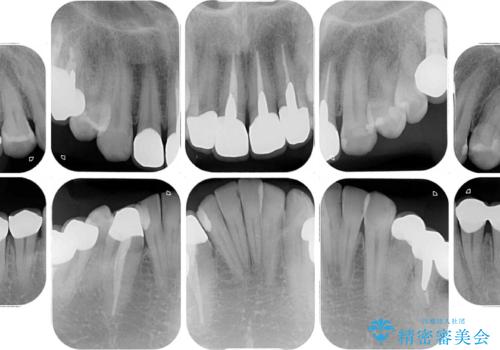 目立つ金属をすべてセラミックに 全顎的メタルフリー治療の治療後