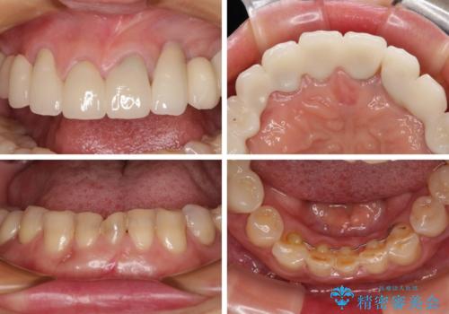割れてしまった歯が痛む 矯正とインプラントを併用した総合歯科治療の治療後
