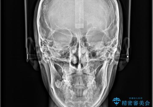 ガタガタの歯並び、八重歯をなおしたい、骨格性下顎前突 カモフラージュ矯正の治療後