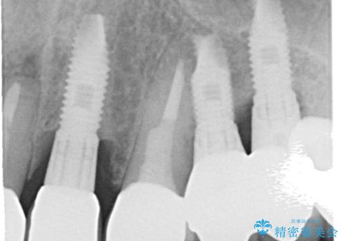 【オールセラミッククラウン・ファイバーコア】被せ物が揺れているの治療後