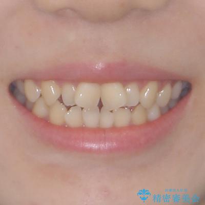 隙間が空いてデコボコした前歯を治したい ワイヤー装置による矯正治療の治療前(顔貌)