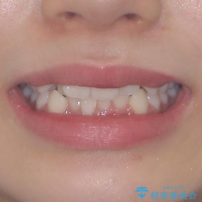 前歯のデコボコとクロスバイトを治したい　ワイヤー装置による抜歯矯正の治療前（顔貌）