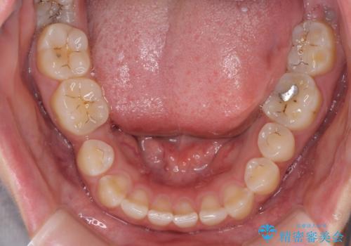 隙間の空いた歯列とボロボロの乳歯 インプラント治療と矯正治療の治療前