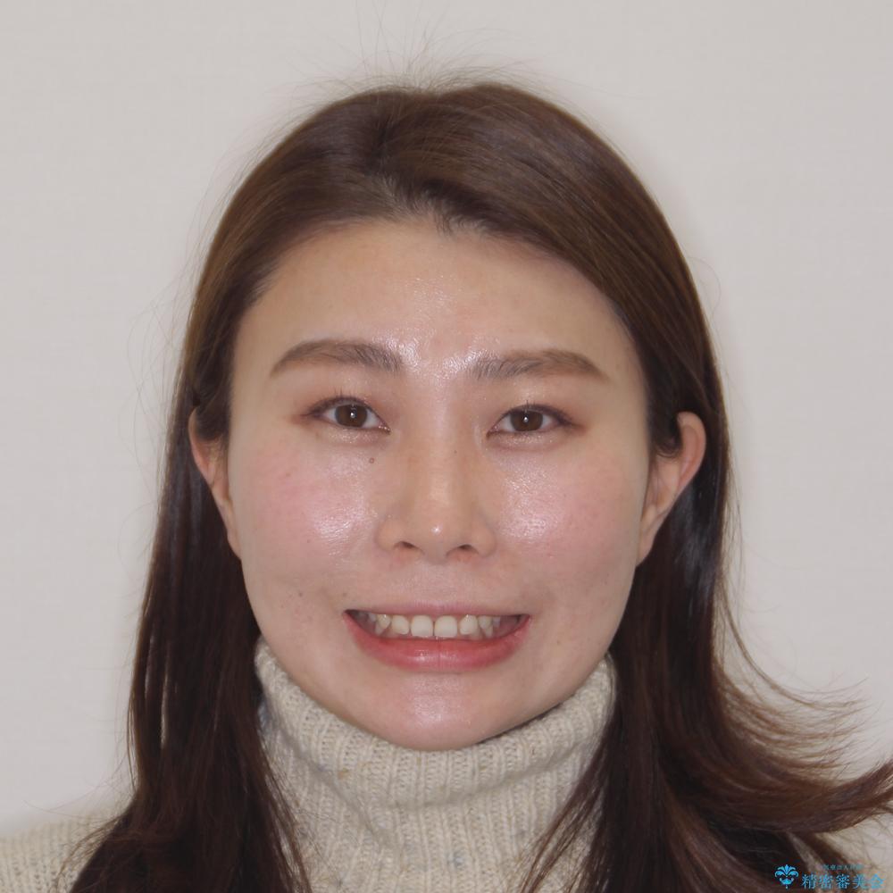 【モニター】ディープバイトを治す ワイヤー装置による矯正治療の治療前(顔貌)