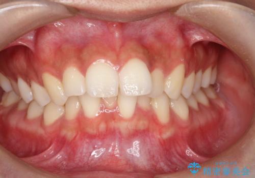 【審美ワイヤー】口元を下げたいの症例 治療前