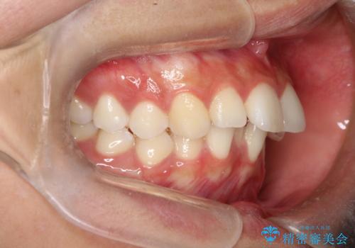 【審美ワイヤー】口元を下げたいの治療前