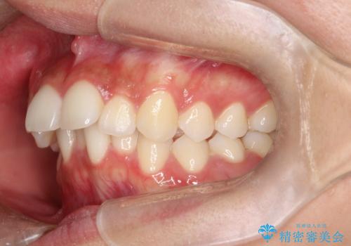 【審美ワイヤー】口元を下げたいの治療前