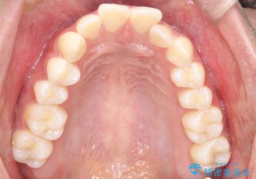 【審美ワイヤー】口元を下げたいの治療前