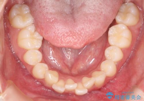 【審美ワイヤー】口元を下げたいの治療前