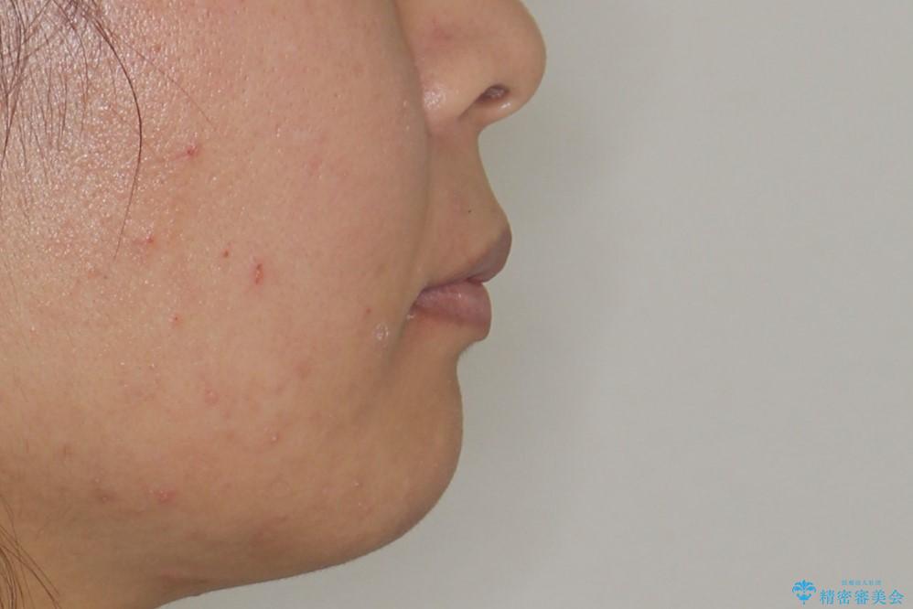 【審美ワイヤー】口元を下げたいの治療前(顔貌)