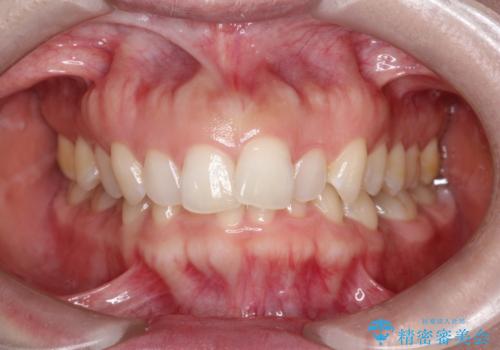 【インビザライン】前歯の凸凹を治したい。の治療前