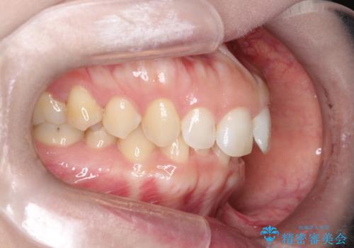 【インビザライン】前歯の凸凹を治したい。の治療前